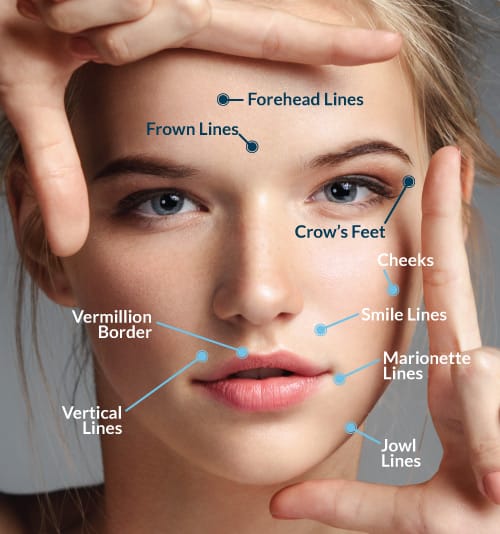 Botulinum toxin injections at Brammeier Family Dental