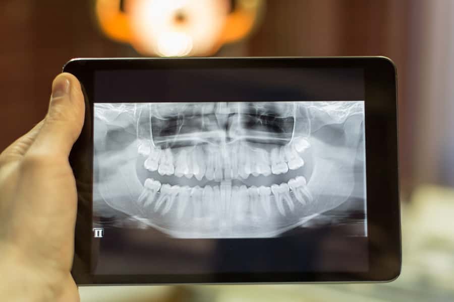 Dexis CariVu near-infrared cavity detection technology at Brammeier Family Dental in Lisle, IL