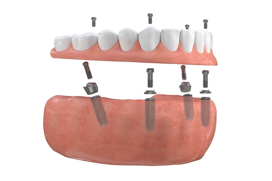 Full-arch implant-supported bridge at Brammeier Family Dental