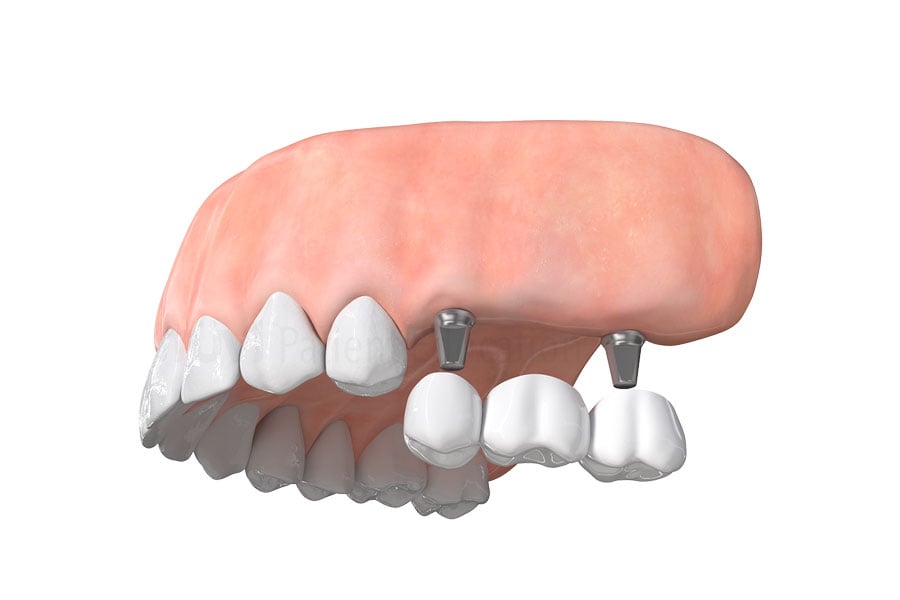 Implant-supported dental bridge at Brammeier Family Dental