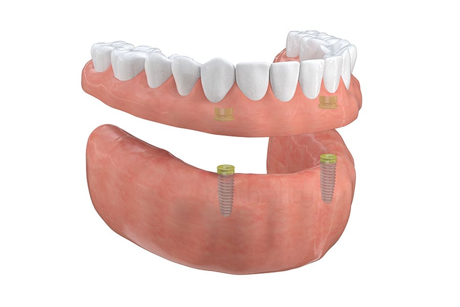Implant-supported overdenture at Brammeier Family Dental