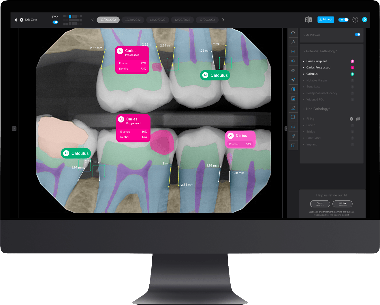 Pearl AI caries detection software displaying X-ray analysis at Brammeier Family Dental