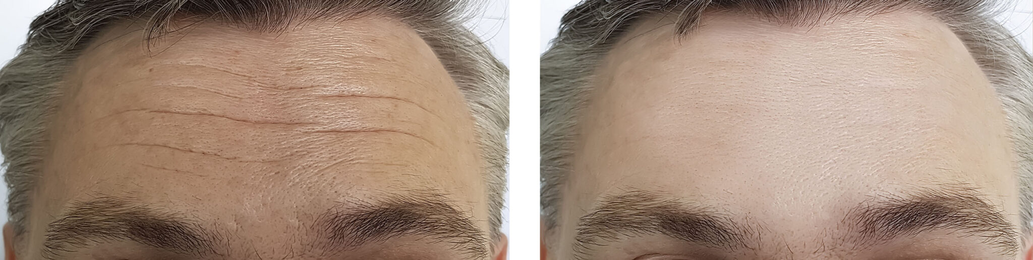 Botox Dentist Lisle, IL - Before and After forehead